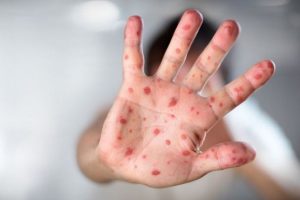 Measles: The Reappearance of Forgotten Diseases