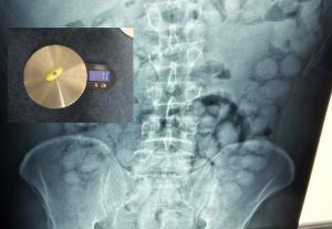 Brazilian Man Nabbed at Athens Airport With 100 Swallowed Packs of Cocaine