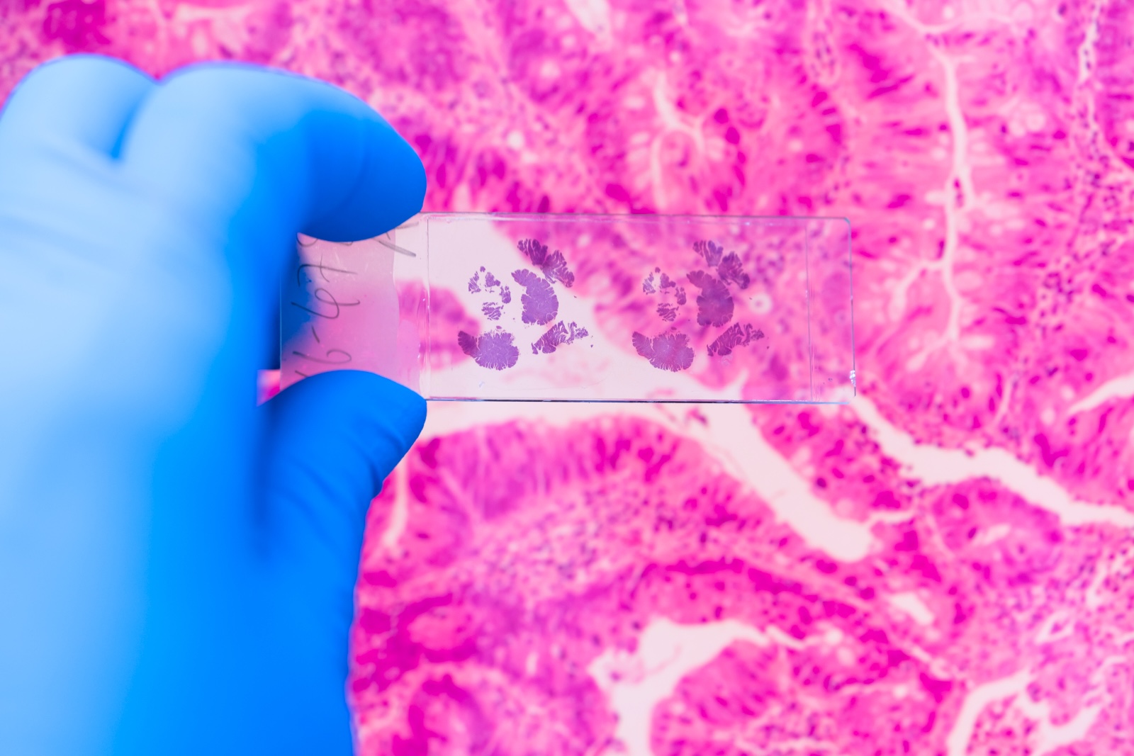 Blood Test Could Revolutionize Early Cancer Detection