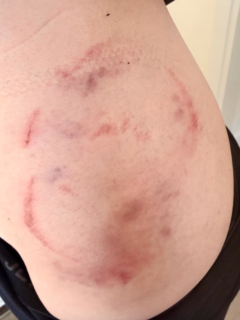 Singer Injured in Caretta Caretta Turtle Bite