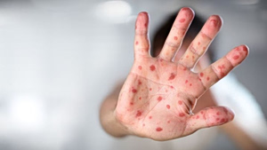 Two Measles Deaths in US Amid Trump Anti-Vaccine Push