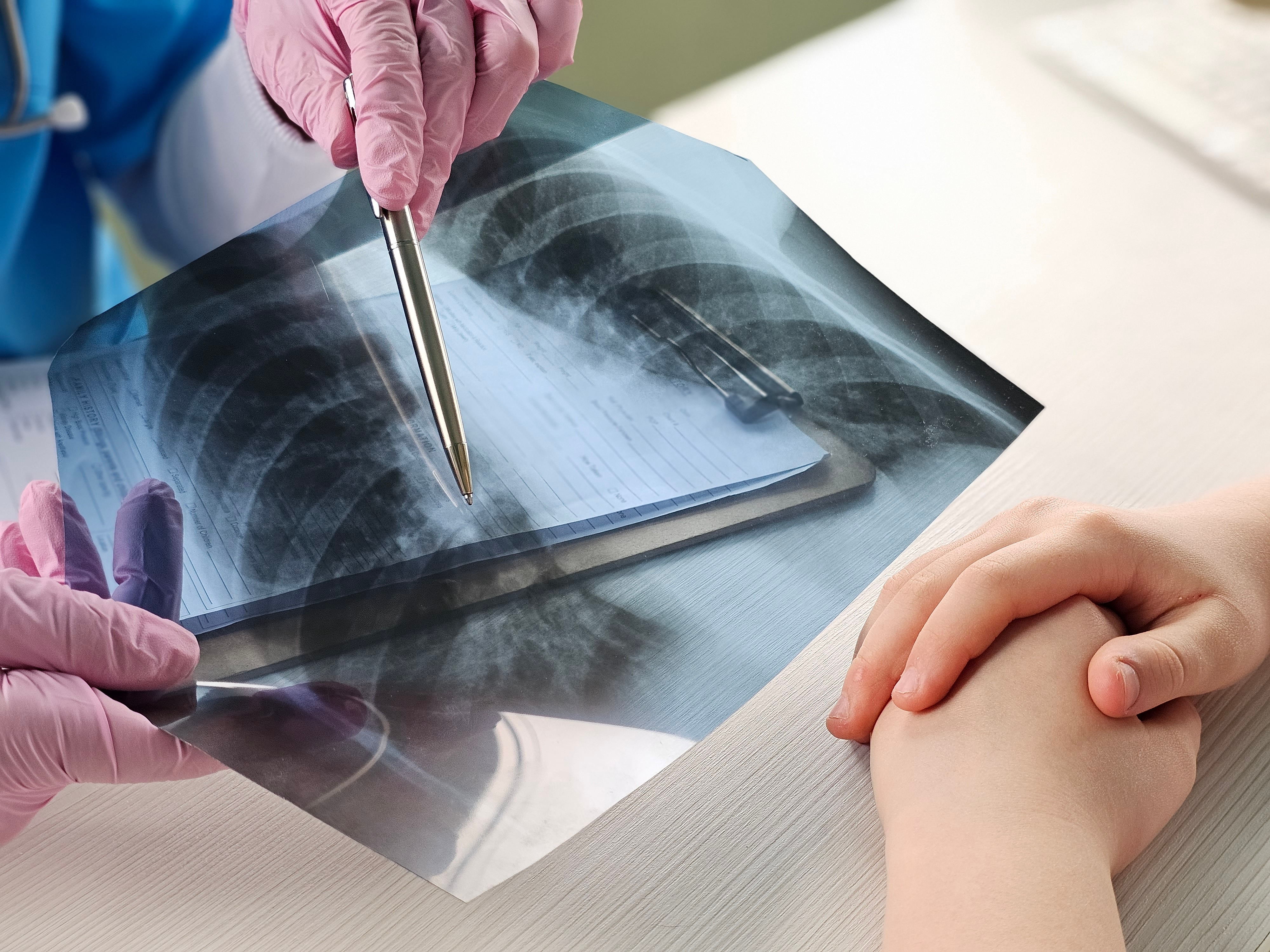 More Than 500,000 People Carry Cystic Fibrosis Gene in Greece
